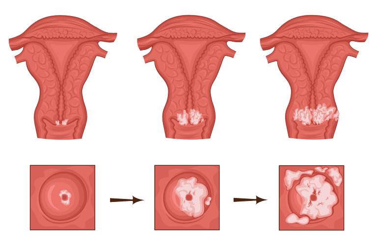 Abnormal Pap smear