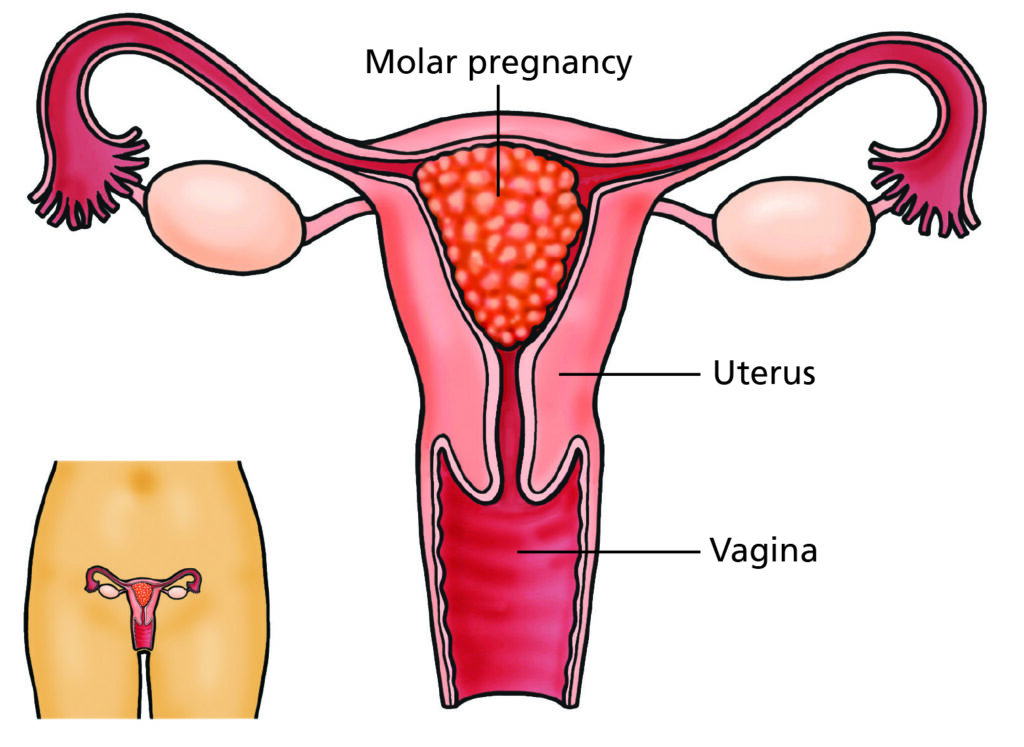 Molar Pregnancy & GTN Treatment