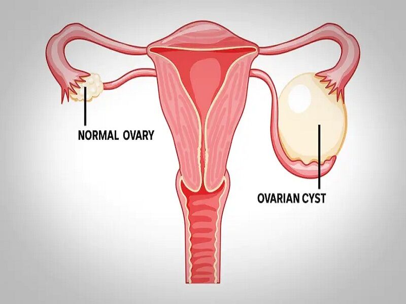 Ovarian Cyst Treatment in Delhi