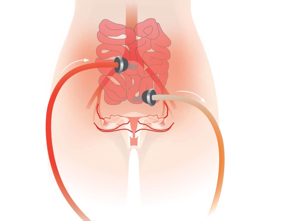 HIPEC Treatment in Delhi | Advanced Cancer Care by Dr. Parminder Kaur