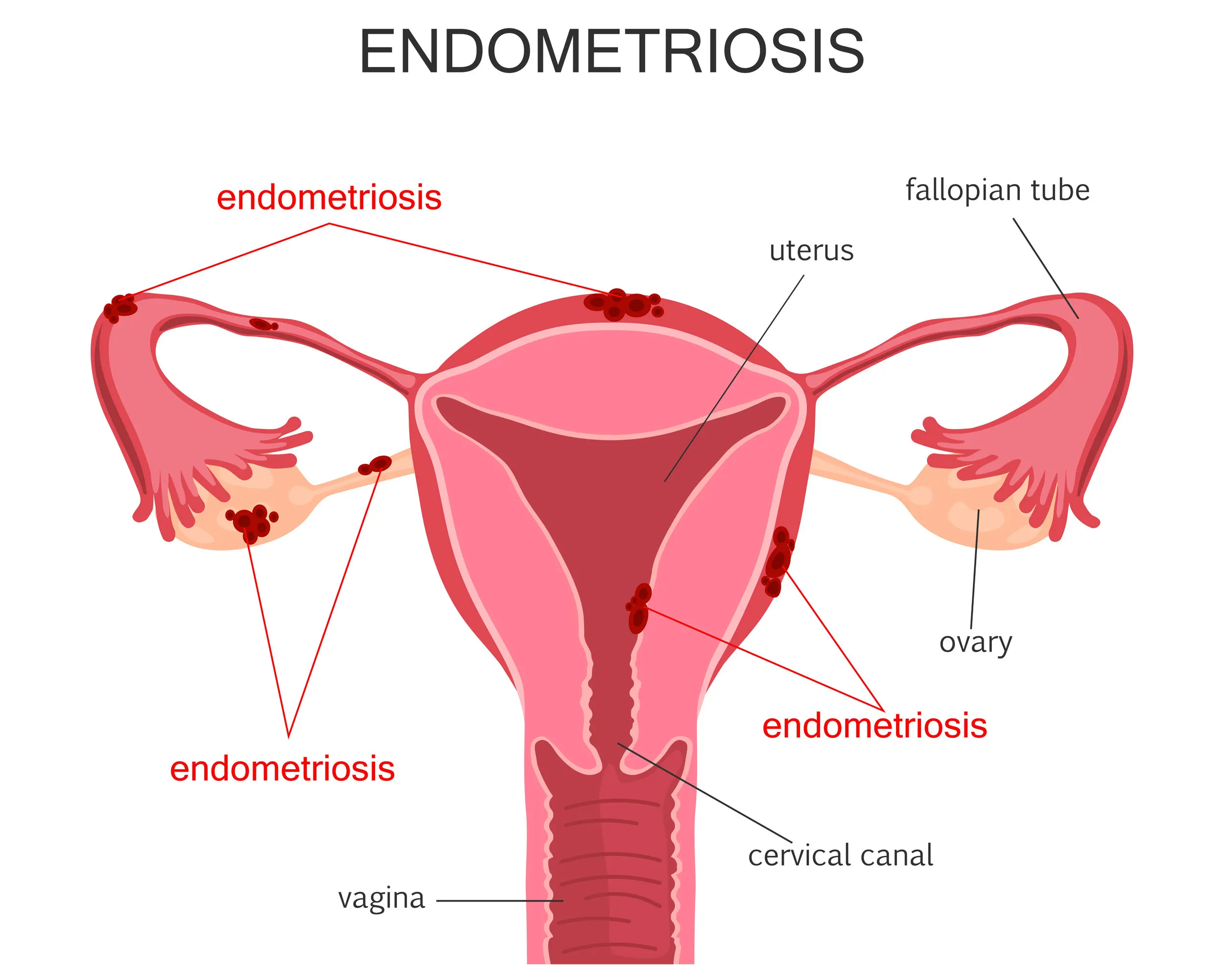 Endometriosis Treatment in Delhi