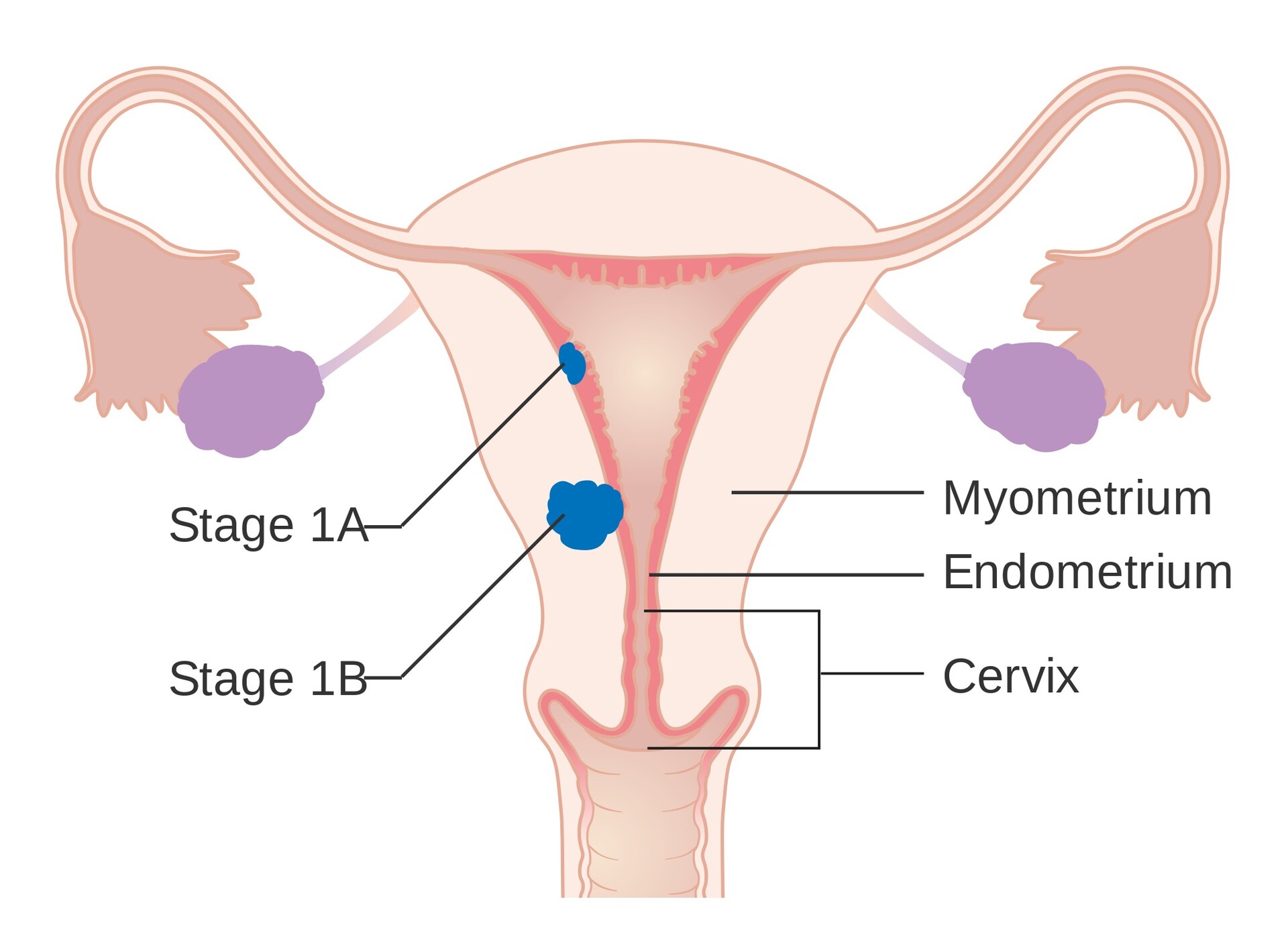 Uterine Sarcoma