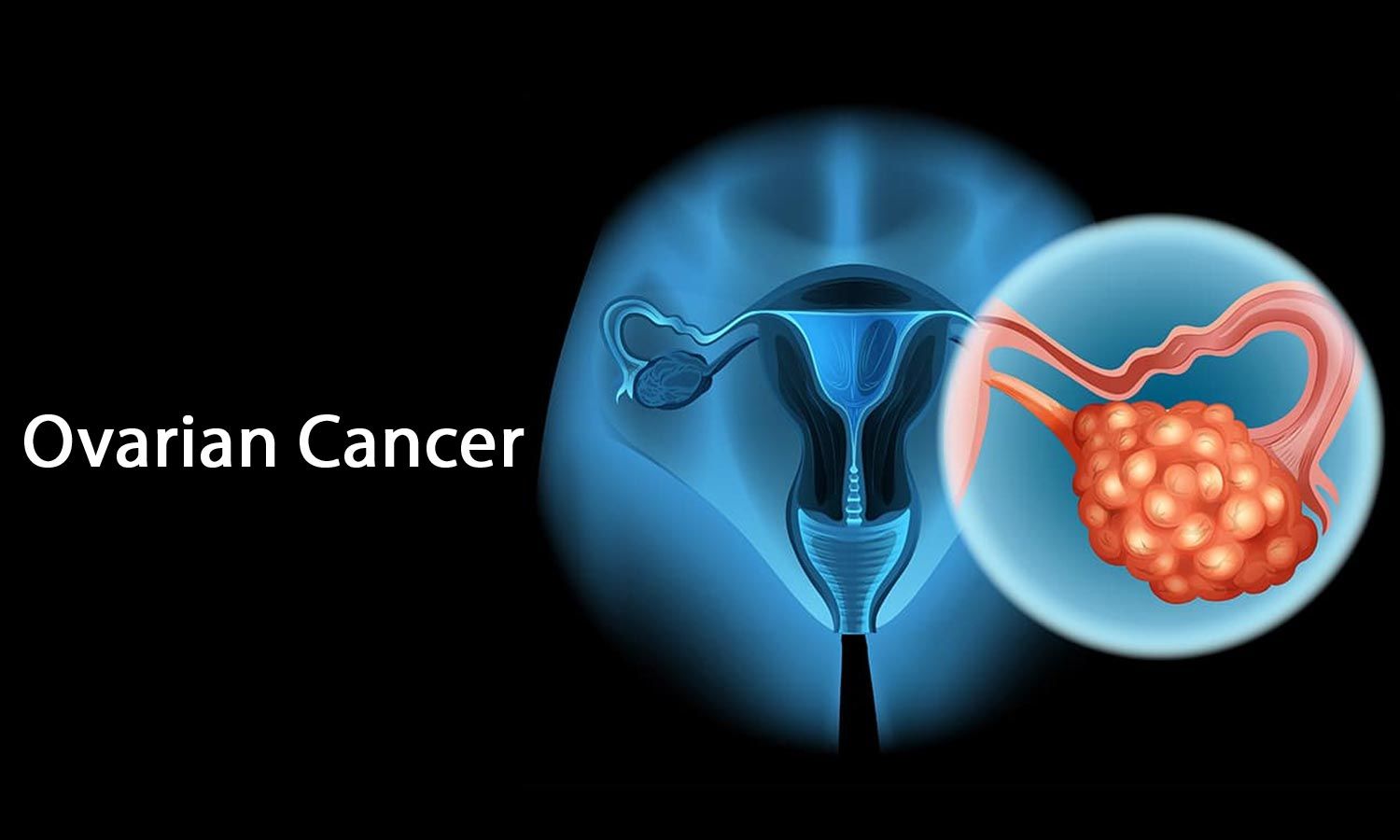 Ovary Cancer Treatment in Delhi